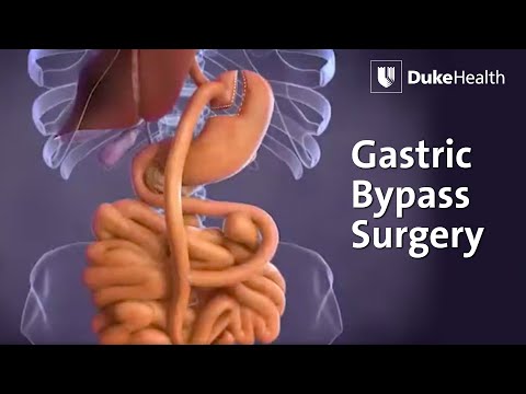 Gastric Bypass Surgery | Duke Health