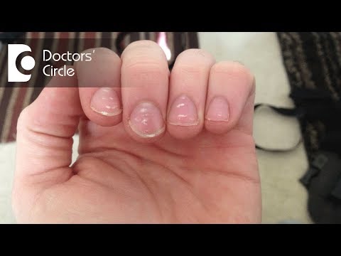 What causes white spots on nails and how to manage them? - Dr. Amee Daxini
