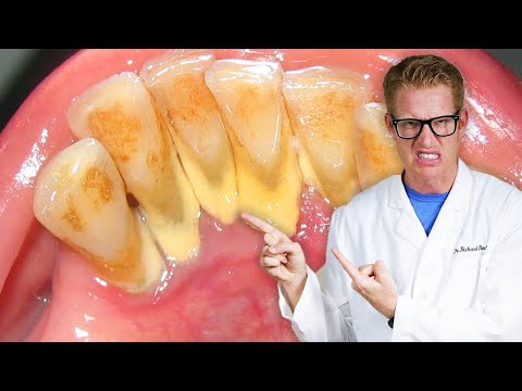 Dentist Explains TOOTH PAIN AFTER DEEP CLEANINGS! Sensitive Teeth, Gums Ache, & Severely Hurt