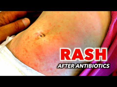 RASH AFTER ANTIBIOTICS!!! (Is this an Allergic Reaction?) | Dr